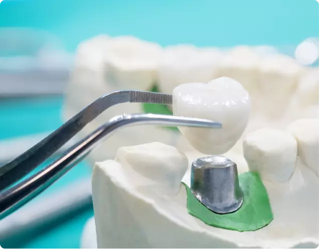 Dental Crowns & Bridges