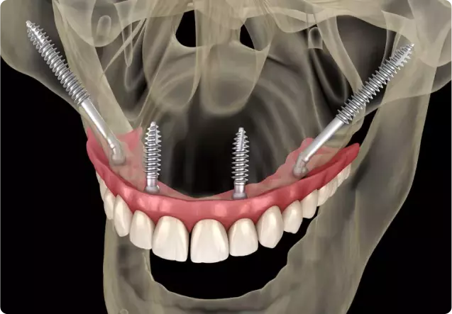 Zirconium Bar Attachment