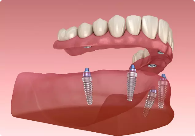 All on 4/Dental Implants