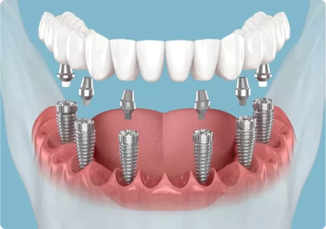 All on 6/Dental Implants