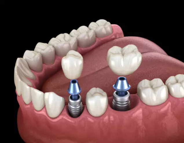 Dental Implant