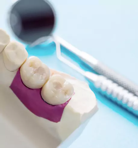 Dental Crowns & Bridges