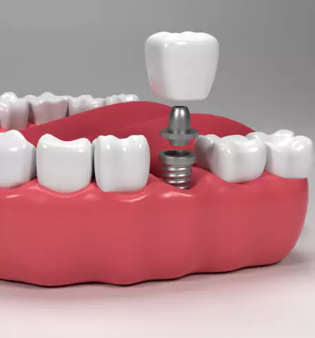 Dental Implants