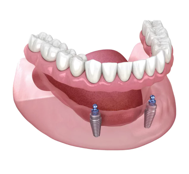 Implant Supported Dentures