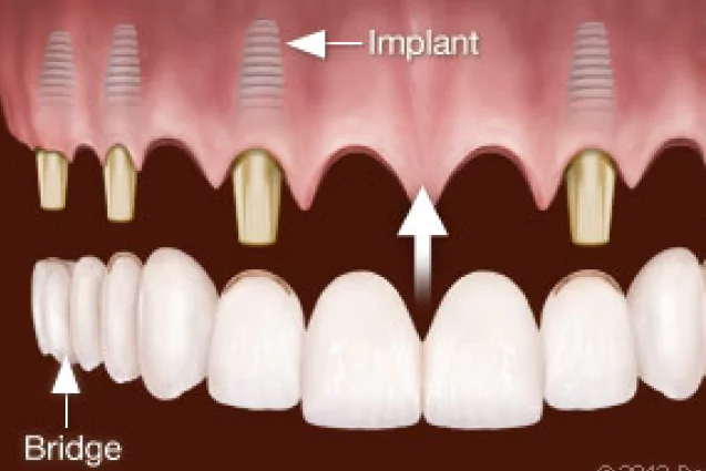 Multiple Implant