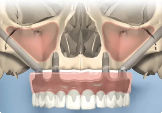 Pterygoid Implants