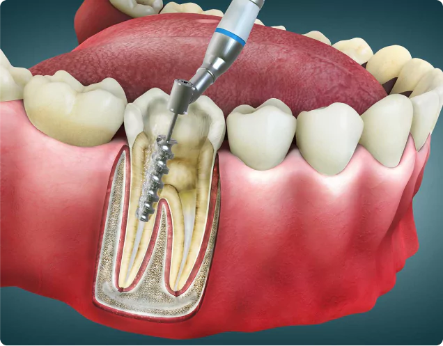 Root Canal Treatment