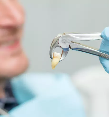 Tooth Extraction